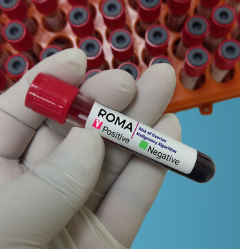 Blood sample tube for analysis of a risk of ovarian malignancy algorithm (ROMA) test in laboratory.