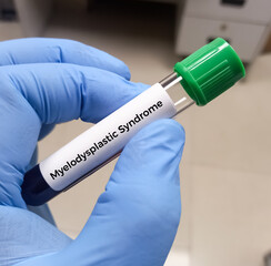 Blood sample for Myelodysplastic syndrome test. To diagnose MDS – a full blood count and a bone...