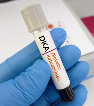 Blood sample for diabetic ketoacidosis (DKA) test. A complication of diabetes that can lead to a coma or even death. life-threatening problem.