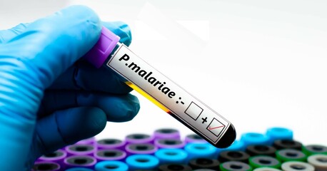 Blood sample of malaria patient positive tested for plasmodium malariae.