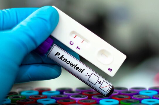 Blood sample of malaria patient positive tested for plasmodium knowlesi by rapid diagnostic test.