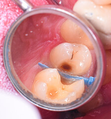 tooth decay and cavity before treatment picture