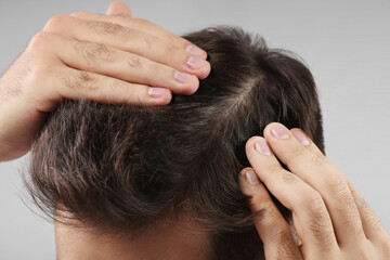 Man examining his head on light grey background, closeup. Dandruff problem