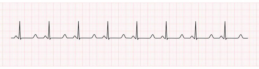 EKG Monitor Showing  Sinus Rhythm with prolong QT interval - obrazy, fototapety, plakaty