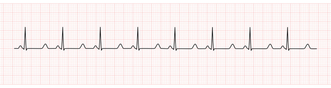 EKG Monitor Showing  Sinus Rhythm with prolong QT interval