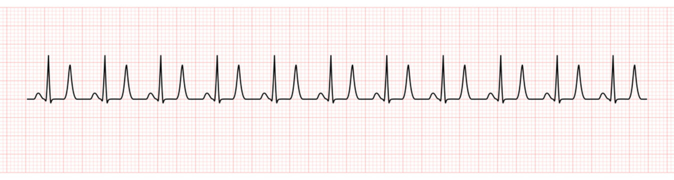 EKG Monitor Showing  Sinus Rhythm with Tall T Wave Represented Hyperkalemia