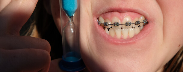 A child's mouth with braces on the upper teeth. Clepsydra. Brushing teeth with braces.