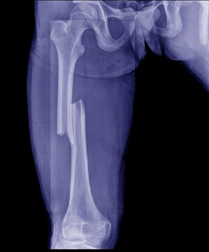 X-ray images of the femur showed a central fracture.