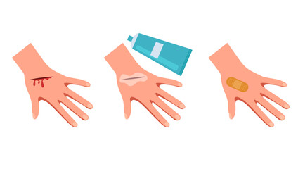 Hand arm with wound treating steps concept. Vector flat graphic design illustration