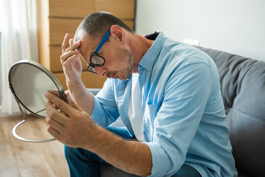 European man with glasses having stress about his hair loss problem. Baldness is related to your genes and male sex hormones. It usually follows pattern of recedinghairline and hair thinning on crown