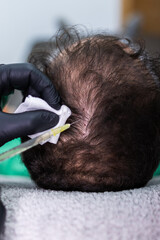 Close-up photo of a doctor's hands injecting a syringe with platelet-rich plasma into his patient's scalp. PRP therapy