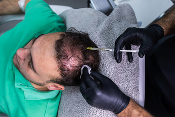 Close-up photo of a doctor's hands injecting platelet-rich plasma into client's scalp against hair...