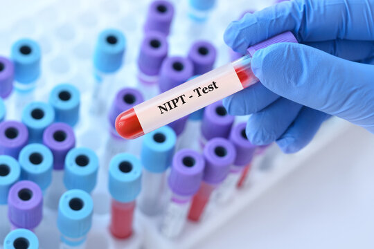 Doctor holding a test blood sample tube with NIPT test on the background of medical test tubes with analyzes
