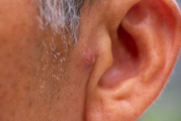Fototapeta premium Close-up view of nodular acne in front of Asian elderly man ear.