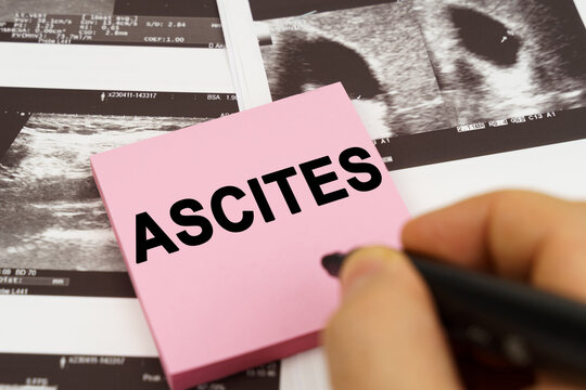 On the ultrasound pictures there are stickers that say - Ascites