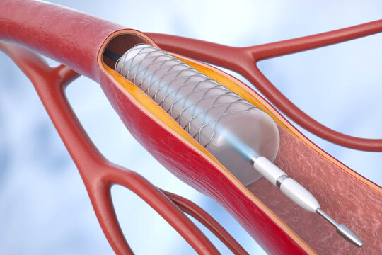 Coronary angioplasty