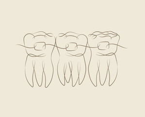 Teeth with braces illustration drawing in linear style on beige background