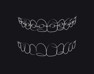 Jaws with and without braces installed drawing in linear style on black background