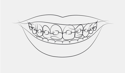 Smile with teeth braces in linear style drawing on white background