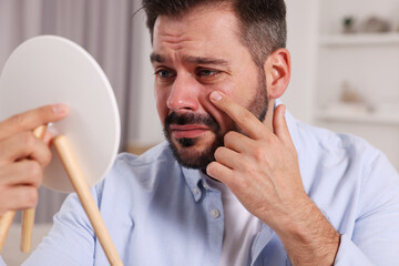 Confused man with skin problem looking at mirror indoors