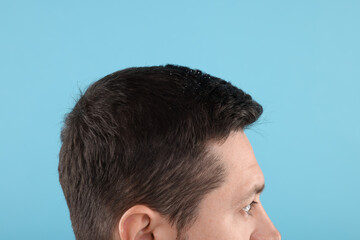 Obraz premium Man with dandruff in his dark hair on light blue background, closeup