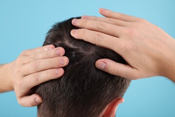 Man with dandruff in his dark hair on light blue background, back view