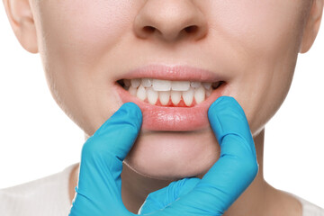 Doctor examining woman's inflamed gum on white background, closeup
