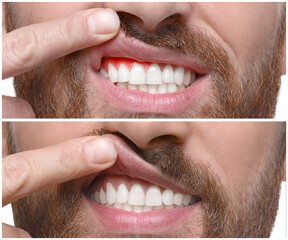 Man showing gum before and after treatment, collage of photos