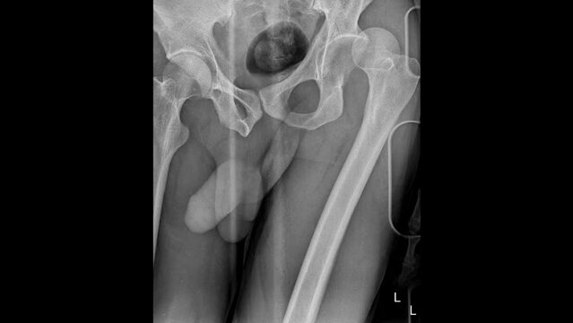 Hip joint dislocation radiograph video 