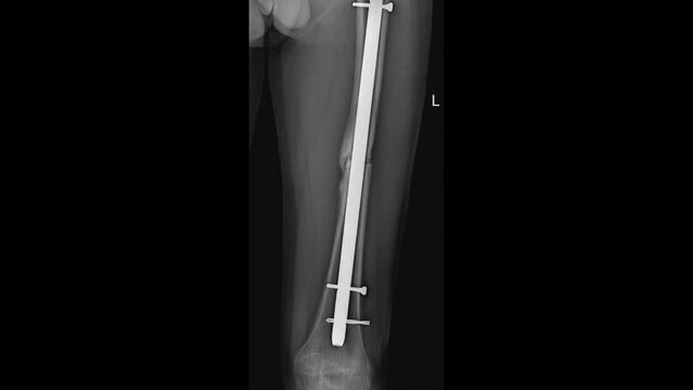 Radiographic image revealing the successful implementation of an intramedullary nail in the femur, offering stability and support for fracture healing.