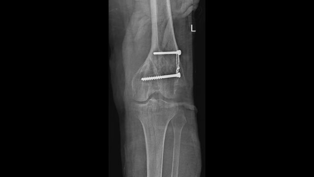 Distal femur fracture fixation radiograph 