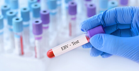 Doctor holding a test blood sample tube with Epstein-Barr Virus (EBV) test on the background of...