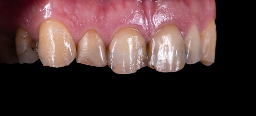 Obraz premium emax crowns and veneers