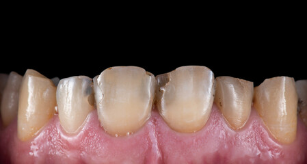 emax crowns and veneers