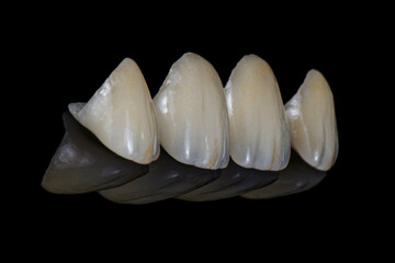 emax crowns and veneers