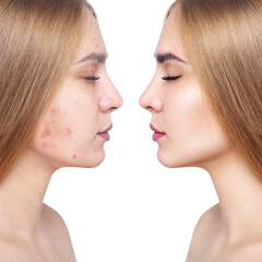 Young woman before and after acne treatment and makeup.