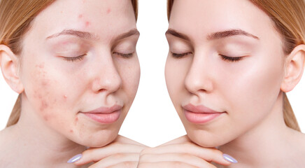 Young woman before and after acne treatment and makeup.