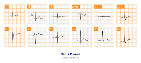Under normal circumstances, the sinus P wave is the first ECG wave, as the sinus node is very small and the electrical activity generated cannot be recorded by the ECG machine.