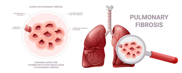 Alveoli in pulmonary fibrosis under magnification. Vector illustration isolated on white background - obrazy, fototapety, plakaty