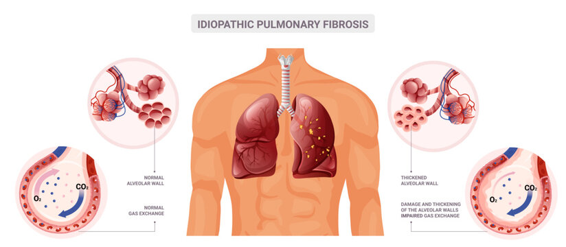 Normal lung and pulmonary fibrosis diagram. Vector illustration isolated on white background