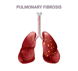 Pulmonary fibrosis and normal lung. Vector illustration isolated on white background