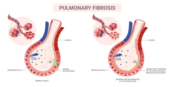 Pulmonary fibrosis alveoli anatomy. Vector illustration isolated on white background
