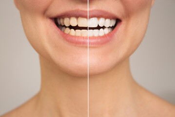 a close-up photo of women's teeth before and after whitening. The concept of comparison. Aesthetic dentistry. Dental care. Teeth whitening