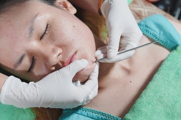 close-up image captures a professional acne treatment in progress at a beauty clinic. The client is comfortably lying on a green towel while the clinician expertly uses a tool for acne extraction.