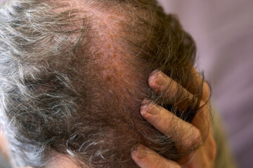 Naklejka premium Close up of hand touching scalp with hair loss problem. 30 year old caucasian man with very thin hair worried about hair loss