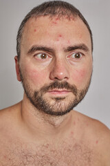 Obraz premium Man with acne, red spots, skin disease. Varicella or Herpes Zoster concept