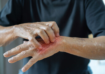 Asian elder man scratching his hand. Concept of itchy skin diseases such as scabies, fungal infection, eczema