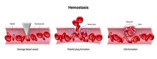 Hemostasis vector. Wound Healing Process Stages. Blood clotting.  - obrazy, fototapety, plakaty