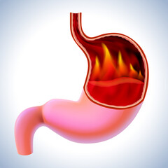 3D illustration of a stomach with flames burning inside is a sign of burning pain, a symptom of gastritis. cut open to see inside For medical, educational, industrial and scientific use