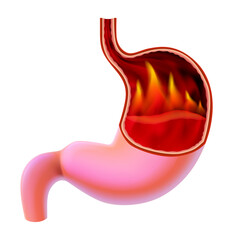 3D illustration of a stomach with flames burning inside is a sign of burning pain, a symptom of gastritis. cut open to see inside For medical, educational, industrial and scientific use